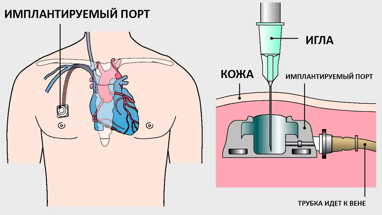Промывание порта для химиотерапии